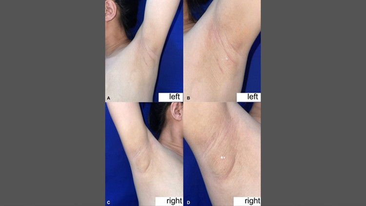 filipinli kadinin koltukaltindan sut geldi nadir gorulen durumun nedeni ne nKHh1s6t.jpg